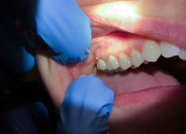 Best Emergency Care for Gum Disease in Long View, NC